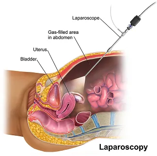 Laparoscopie ou coelioscopie — illustration 2