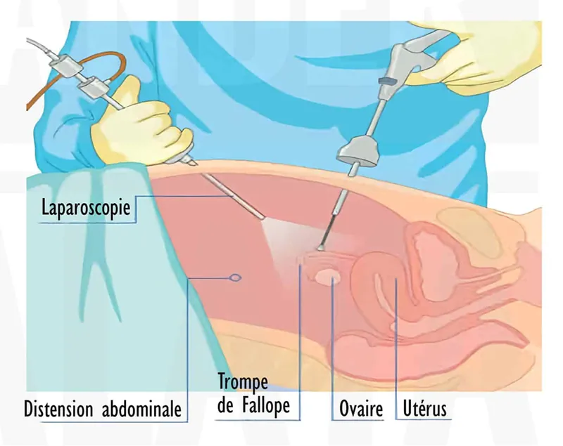 Laparoscopie ou coelioscopie — illustration 4