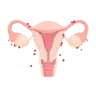 Endométriose