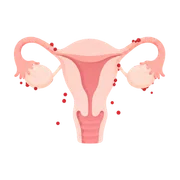 Endométriose Endométriose