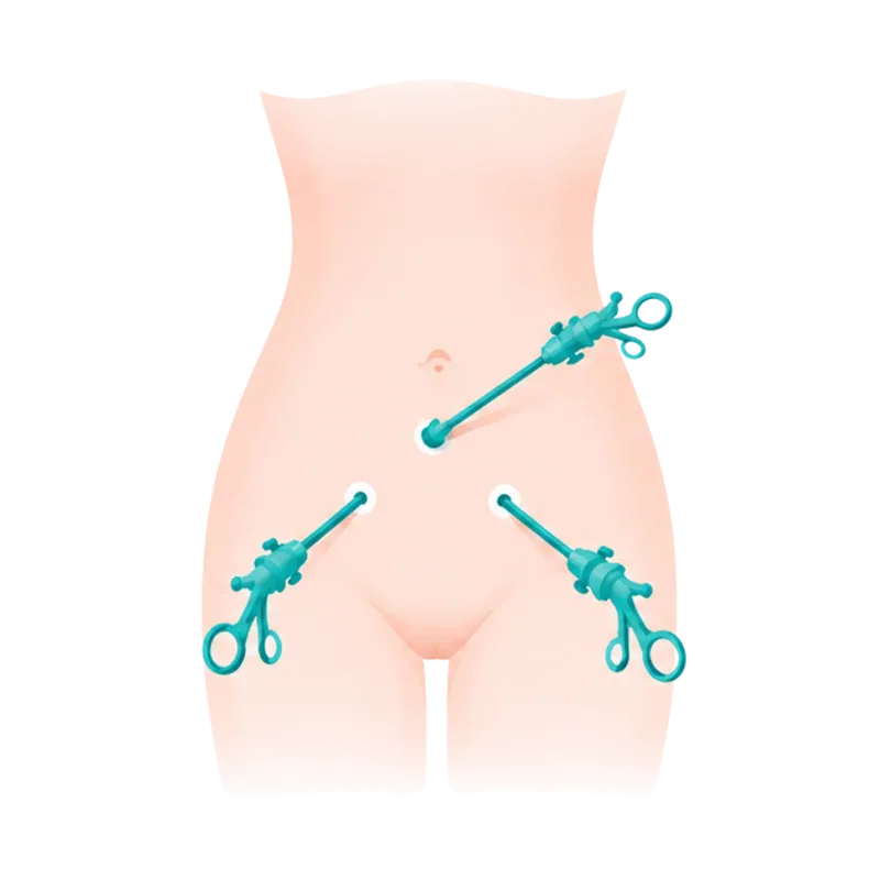 Laparoscopie ou coelioscopie — illustration 1