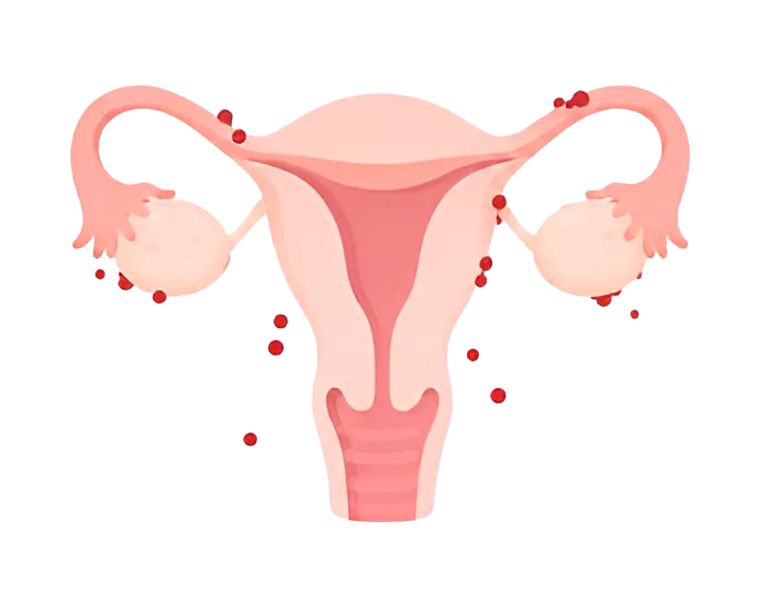 Endométriose — illustration 1