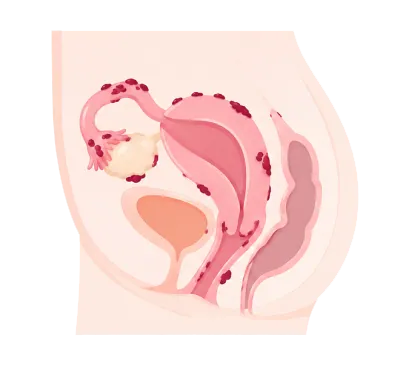 Endométriose — illustration 2