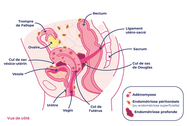 Endométriose — illustration 3