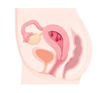 Polype utérin — illustration 2
